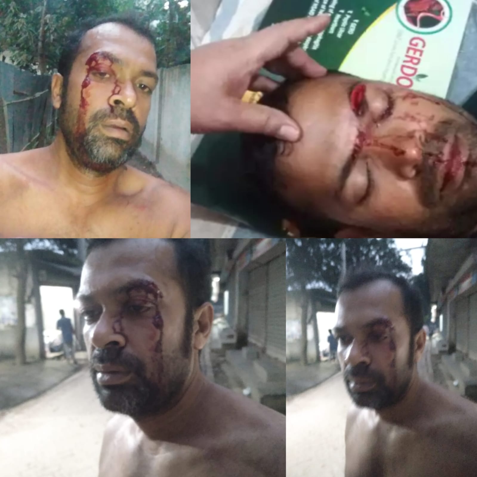 সোনারগাঁয়ে চাঁদা দাবিতে হামলা, নির্মাণকাজ বন্ধের হুমকি: আহত ১